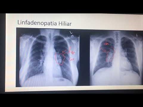 Lección 17. Linfadenopatia Hiliar. Signo Superposiciones Hilio. Radiografía Torax