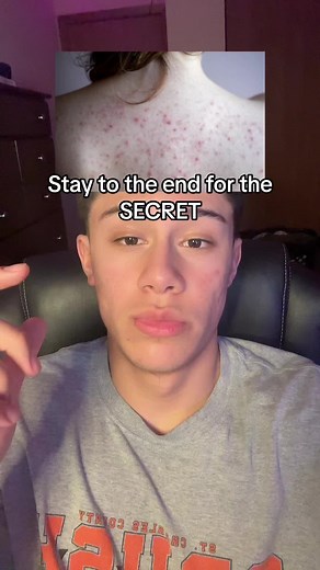 The Ultimate Solution for Back Acne: Glycolic Acid Benefits and How to Use It