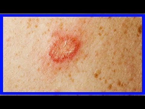 Was gegen Pilzerkrankungen hilft