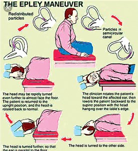 Youtube vertigo treatment epley maneuver