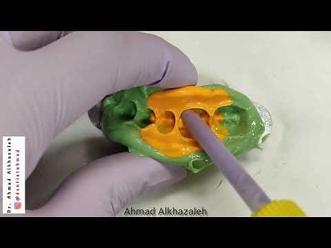 🎇 indirect class II restoration using resin composite! ✅ anatomy and contours on point!! ✅