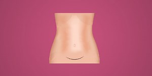 Cesarean Delivery Nursing Care Plan and Management - RNpedia