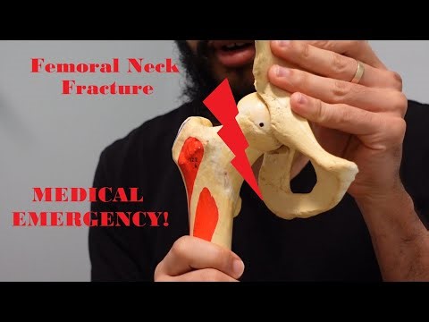 Femur Muscle Attachments, Femoral Head Necrosis, and Hip Movements