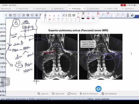 Pancoast Tumor: Horner Syndrome, Brachial Plexus, SVC Syndrome | Superior Sulcus Tumor Explained