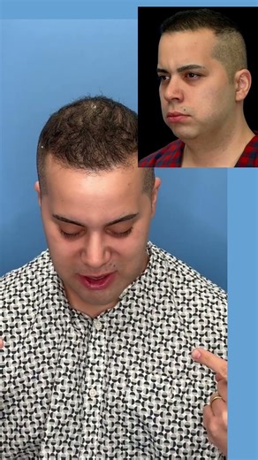 One implant. Total profile transformation. #beforeandafter #naturalresults #chinimplant