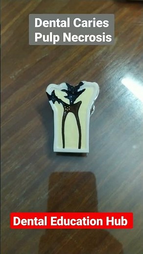 Dental Caries Teeth Model | Cavities in teeth