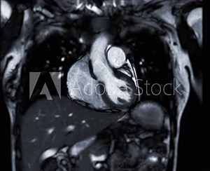 MRI heart or Cardiac MRI ( magnetic resonance imaging ) of coronal view showing heart beating for detecting heart disease.