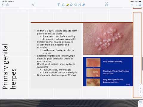 HSV 2 infections