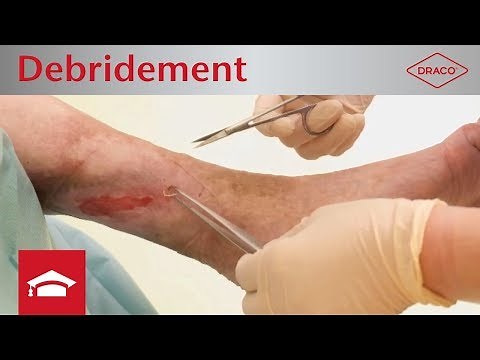 Debridement - Wundreinigung: Nekrosen & Wundbeläge entfernen - Debridementarten erklärt