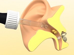 Otex Express Combi Pack Drops and Ear Syringe, 10ml