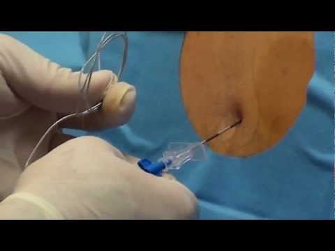 Epidural Steroid Injection