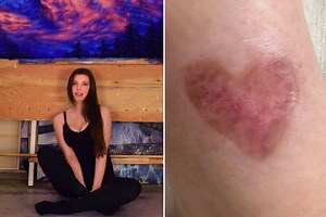 Woman Stunned When Rare Flesh-Eating Spider Bite Turns Into the Unexpected