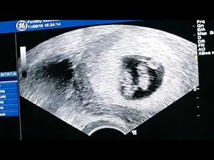 6 Week Ultrasound, its twins!