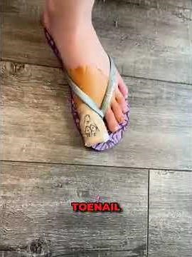 👨‍⚕️ Matrixectomy Explained: Permanent Solution for Ingrown Toenails