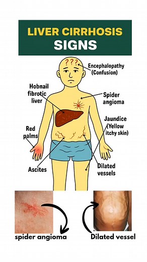 16 reactions | Liver cirrhosis is not just a disease — it’s a warning...