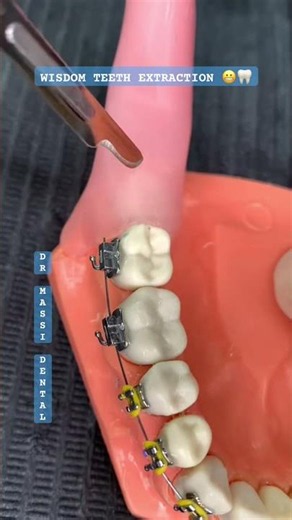 WISDOM TEETH EXTRACTION 😬🦷