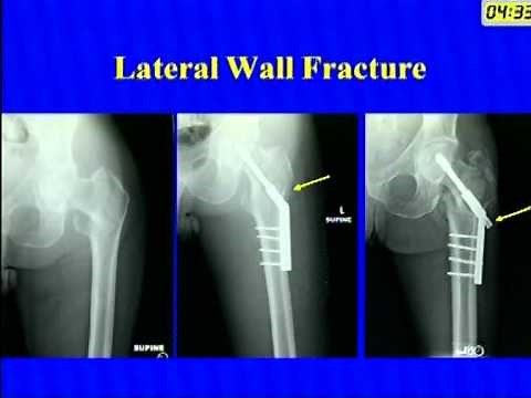 Peritrochanteric Fractures- DHS Vs IM Nail