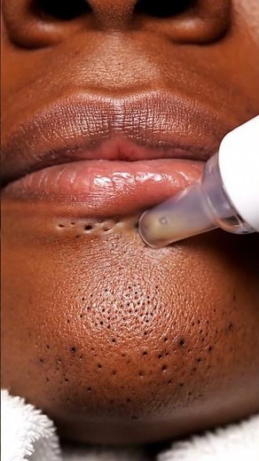 Extreme Blackhead Removal ASMR 🔥