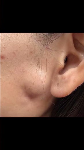 Cheeky cyst - full video tagged to watch the sac removal (and a bonus blackhead) #drpimplepopper