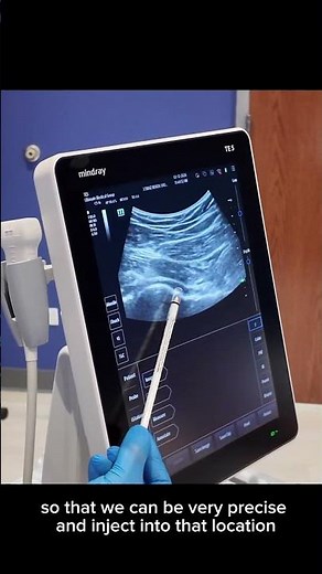 HIP PAIN, HIP LABRUM PAIN, SNAPPING HIP PAIN, PRP A2M ULTRASOUND GUIDED INJECTION