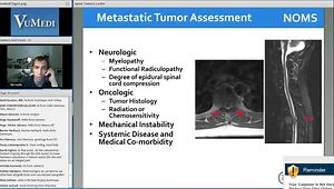 Management of Metastatic Spine Disease