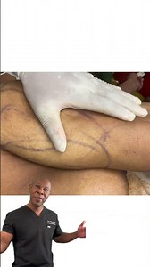 Lipo of Arms by Dr. Pakeman aka Real Dr Manhattan ( Real results- Real patients⭐️