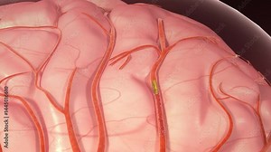 3D animation of ischemic stroke. Arterial thrombosis can block the arteries, leading to brain cell necrosis, brain tissue damage, cerebral infarction, stroke, and cerebral hemorrhage.