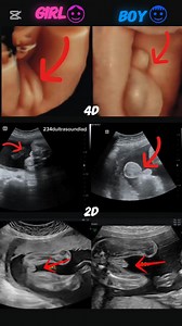 5M views · 3.7K reactions | What bundle of joy are you carrying#ultrasound #pregnancy #babyboy #genderreveal #babygirl #imaging #gynaecology #obstetrics | 234Dultrasoundlad | Facebook