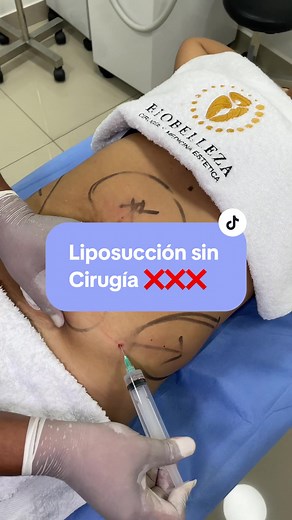 Tratamiento de Hidrolipoclasia: Reducción de Celulitis y Grasa