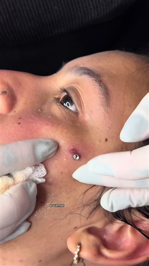 Remoção de Microdermal: Dicas e Cuidados Essenciais