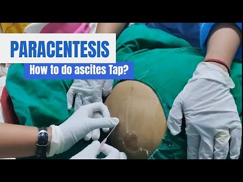 #Paracentesis Procedure: #Ascites #Tap in detail