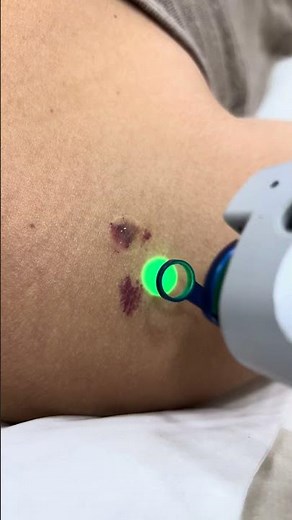 Watch a V-Beam Laser Remove a Port Wine Stain 🔴 ⭐