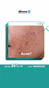 Keep acne at bay with our 3-step Acne Care Kit! It deeply cleanses, fights breakouts and moisturizes skin to give you visible results with consistent use. Cart now! | The Derma Co.