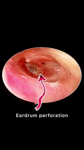 How does traumatic eardrum perforation heals?