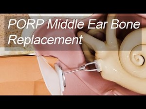 How Middle Ear Bones Can be Replaced with Implants