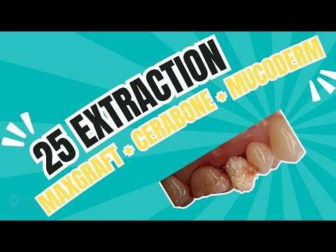 25 extraction + maxgraft + cerabone + mucoderm