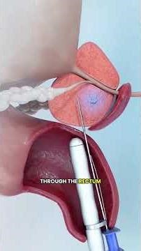 What Happens During a Prostate Biopsy? 🇱🇷 (3D Animation)