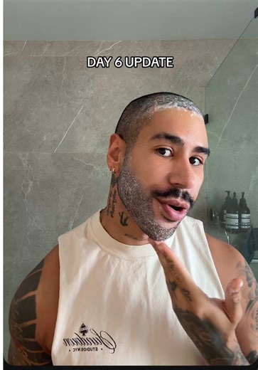 Day 6 update 👀 #hairtransplant #turkey #menshair #beardtransplant | hair transplant