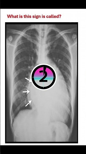 Classic CXR Sign of Left Atrial Enlargement high yield MCQ