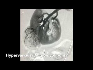 Renal Angiomyolipoma (AML) Transcatheter Ethanol (Alcohol) Embolization