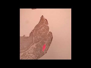 B-cell Lymphoma With Plasmacytic Differentiation