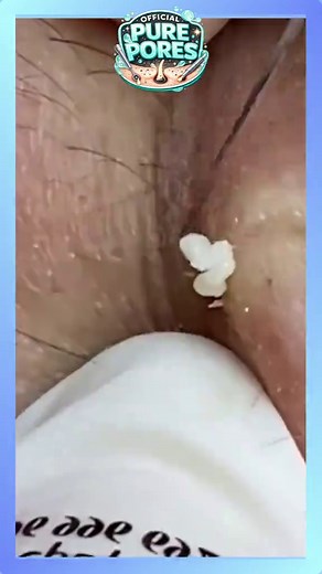 Extreme Blackhead Removal and Deep Pore Cleansing ASMR