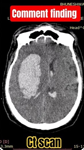 comment finding, ct scan #anatomy #allaboutradio