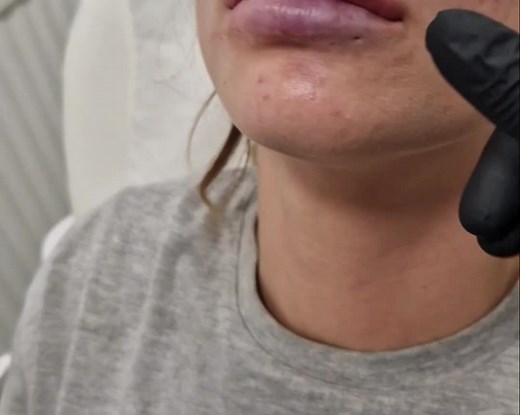 Vessel Occlusion: How to Identify and Deal with Dermal Filler Complications