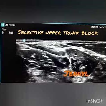 How to perform selective upper trunk brachial plexus block