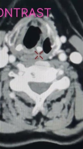 Neck mass ct scan with contrast.
