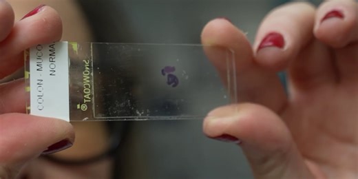 Rare But Rising: Appendix Cancer Rates Triple