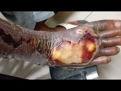 Foot gangrene / diabetic + traumatic + infective