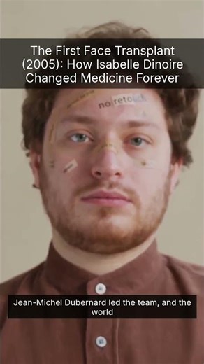 The First Face Transplant (2005): How Isabelle Dinoire Changed Medicine Forever