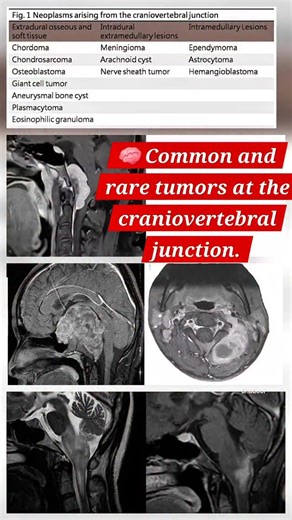 Adeel Ur Rehman on Instagram: "Craniovertebral Junction Tumors | Must-Know MRI & CT Signs 🧠 Small region. Big impact. High-yield imaging. This reel highlights the most important tumors of the craniovertebral junction (CVJ) and how they appear on MRI & CT — from subtle infiltrative lesions to aggressive masses. 📌 Covered in this reel: • Chordoma • Meningioma • Hemangioblastoma • Neurofibroma (NF-1) • Astrocytoma • Osteosarcoma 🎯 Perfect for radiology residents, medical students, and neuroimagi